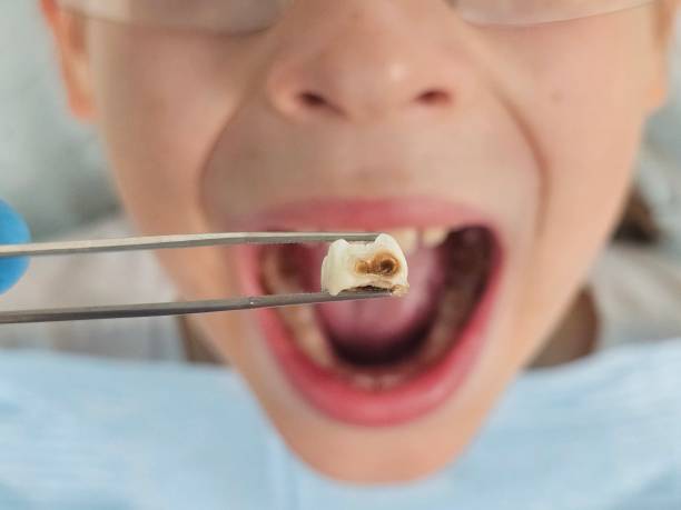 Best Emergency Wisdom Teeth Removal in Bellemont, AZ